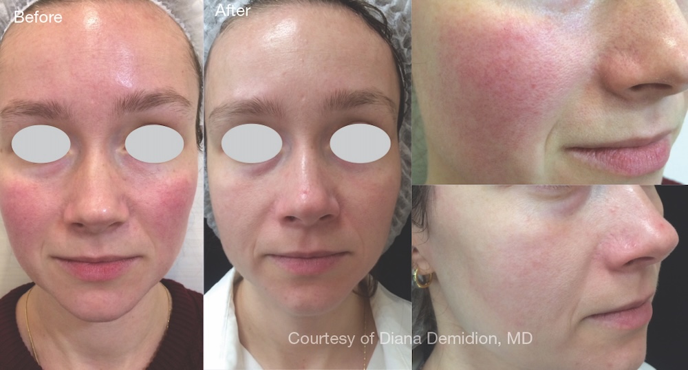 Before and after of female patient who received an IPL treatment