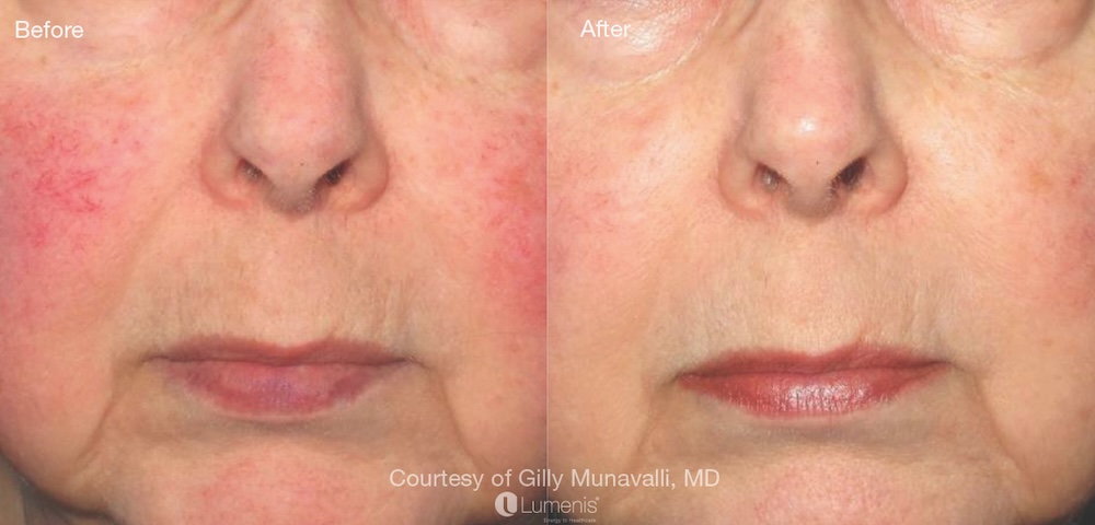 IPL treatment fefore and after images of patient with Rosacea.