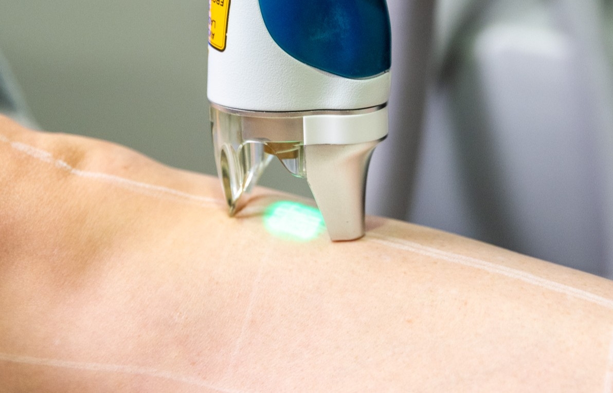 Patient getting laser hair removal treatment on lower leg
